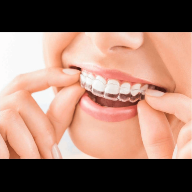 Clear Aligners