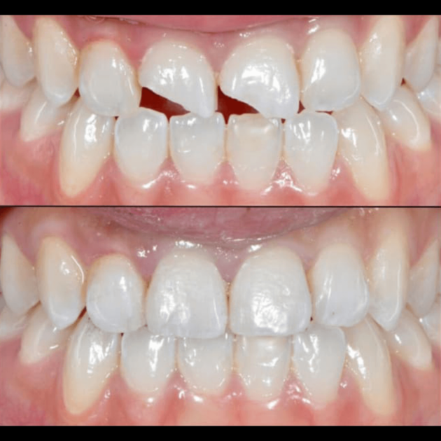 Composite Restoration