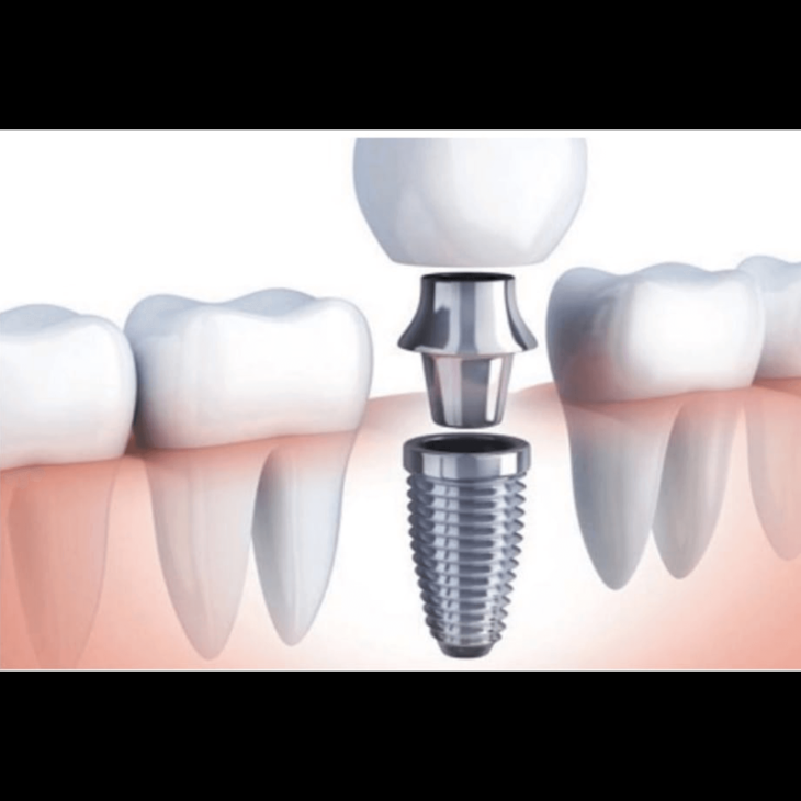 Implant Placement
