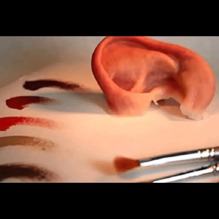 Maxillofacial Prosthesis