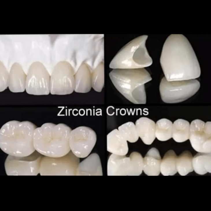 Zirconia FPD